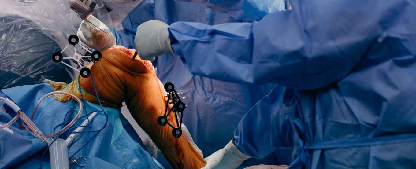 Robotic Assisted vs. Conventional Total Knee Replacement: Which Is Right for You?